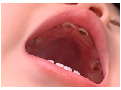 河北惟德口腔涂氟流程簡單，孩子配合度拉滿