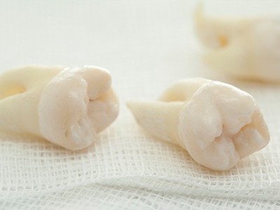 智齒疼了，這牙非拔不可嗎？