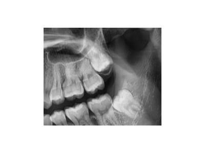既然「智齒」不宜久留，為什么不能一次性拔掉？