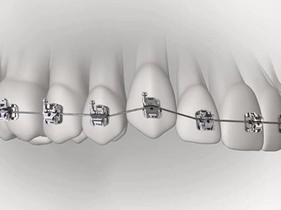 承德市哪家口腔醫(yī)院口腔正畸做得好？惟德口腔醫(yī)院來(lái)告訴您