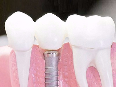 在承德口腔種植齒需要多少錢？惟德口腔一一為您道來(lái)